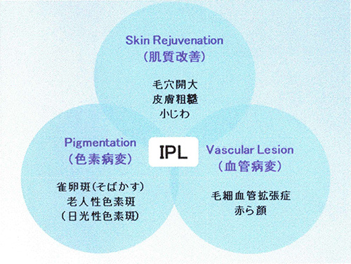 IPLの説明図